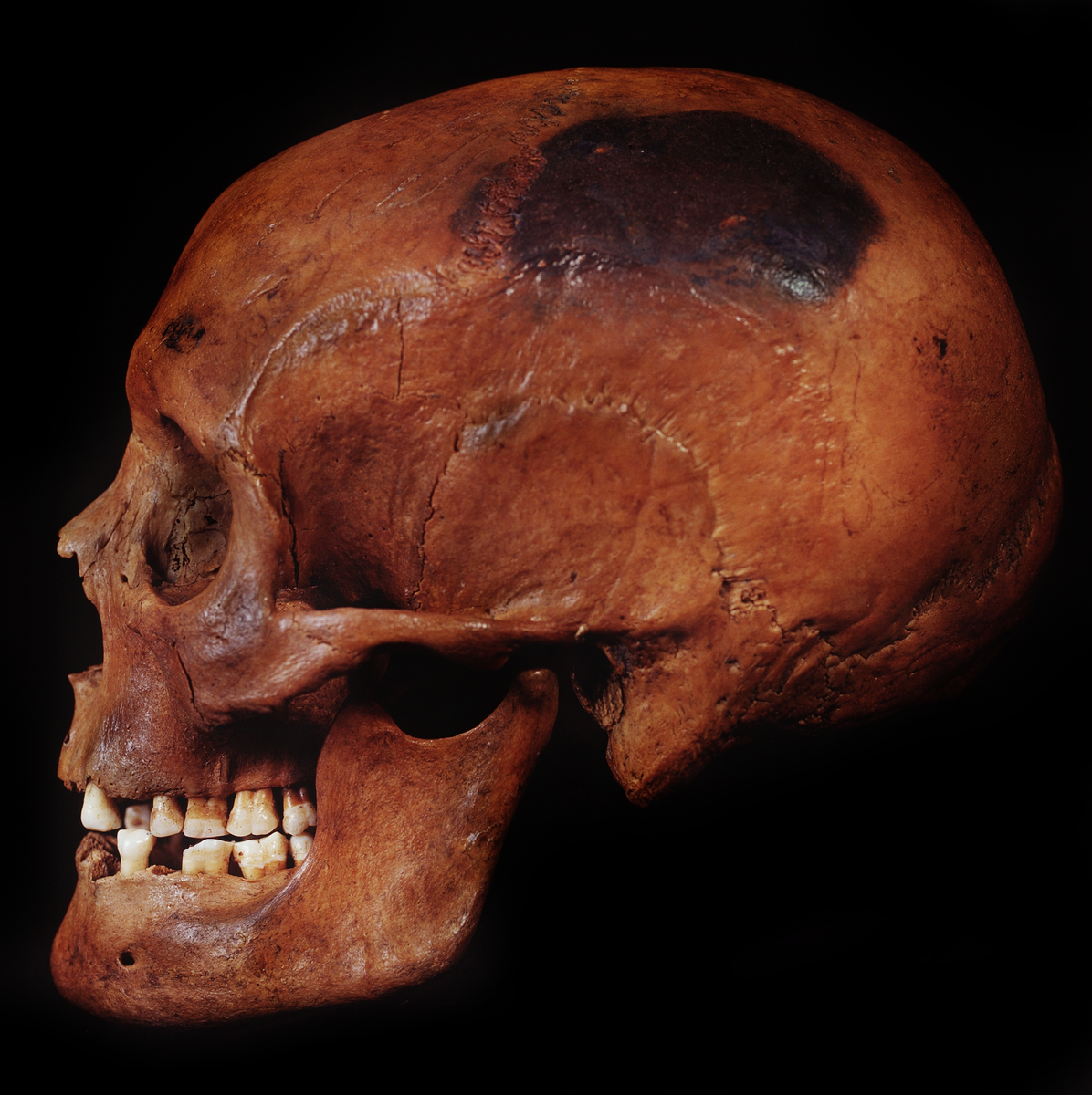 Kranium med 10 tänder.
Cranium.