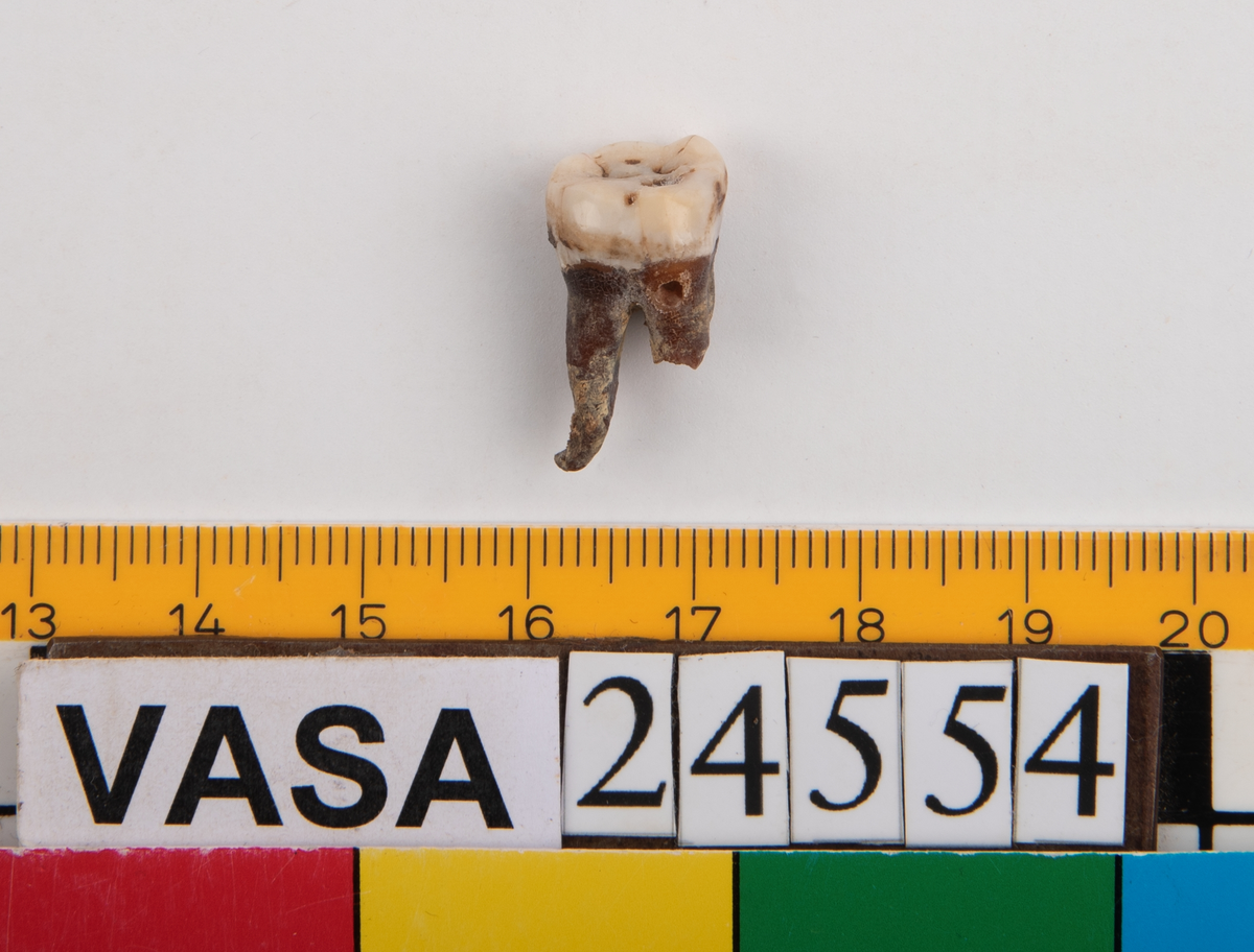 Visdomstanden (tredje molaren) på höger sida i underkäken.
Tandens ena rot sitter kvar i käken.
Molar 3, dexter, mandibula.