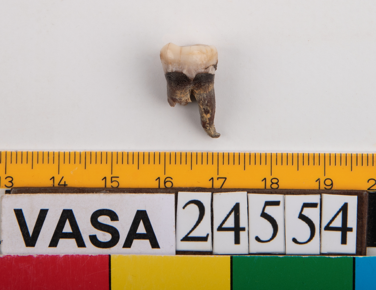 Visdomstanden (tredje molaren) på höger sida i underkäken.
Tandens ena rot sitter kvar i käken.
Molar 3, dexter, mandibula.