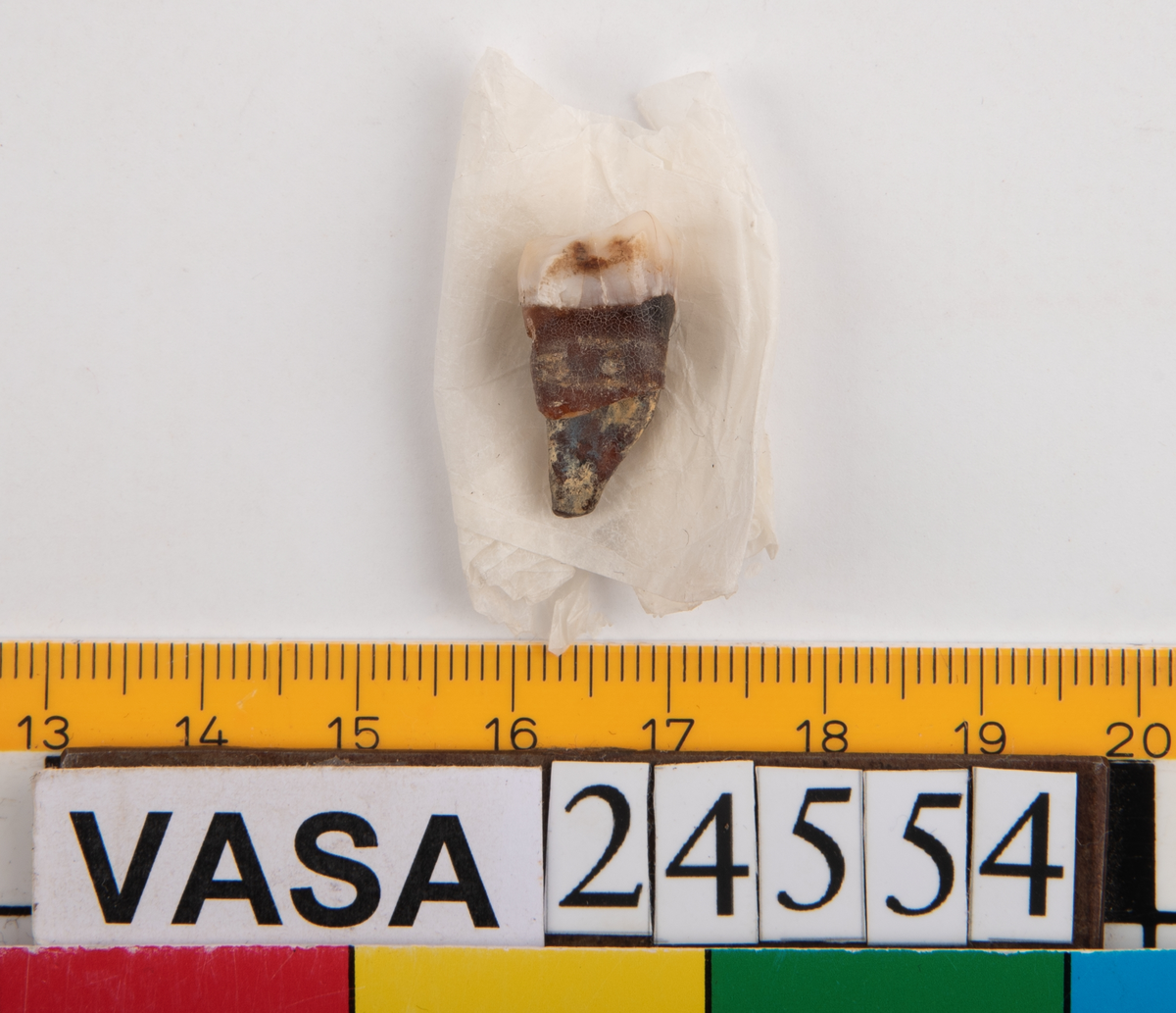 Visdomstanden (tredje molaren) på höger sida i underkäken.
Tandens ena rot sitter kvar i käken.
Molar 3, dexter, mandibula.