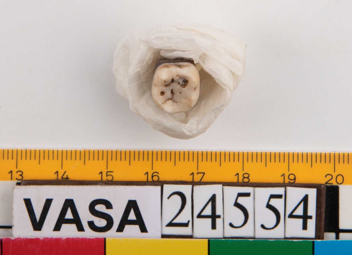 Visdomstanden (tredje molaren) på höger sida i underkäken.
Tandens ena rot sitter kvar i käken.
Molar 3, dexter, mandibula.