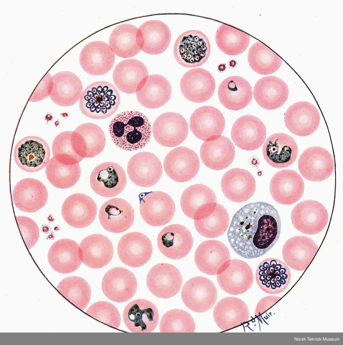 Mikroskopbilde, Malaria, Benign Tertian