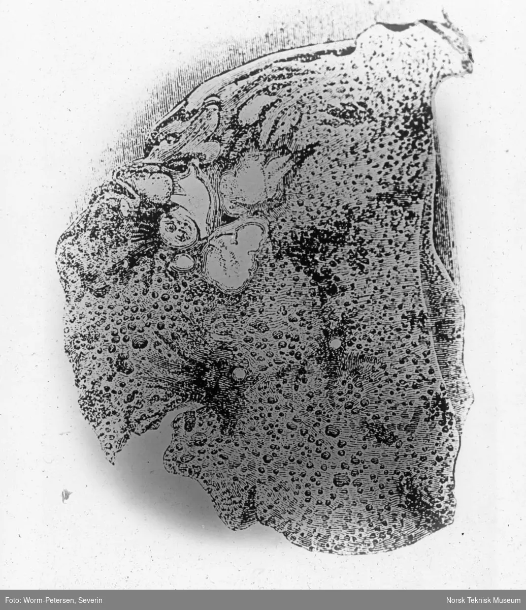 Illustrasjon av helbredet tuberkulose, lunge