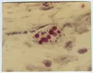 'Mikroskopbilder på amöba: :: Text på baksidan av fotot: ''Haematophagus Entamoeba histolytica in section of intestinal wall x 2000. 8515-217.'' ::  :: Ingår i serie med fotonr. 5653:1-16.'