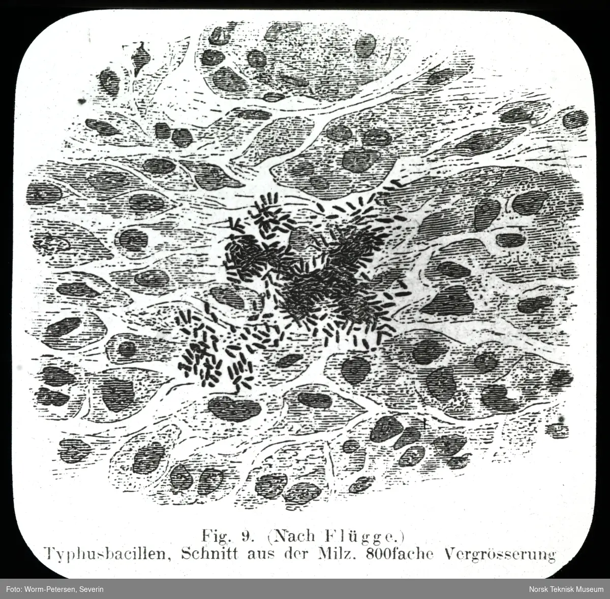 Illustrasjon av helbredet tuberkulose, lunge