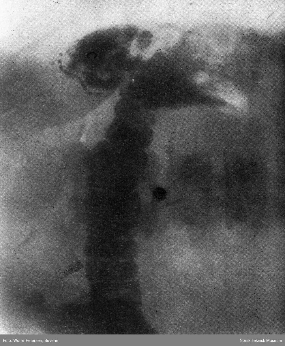 Røntgenbilde mageregion / tykktarm