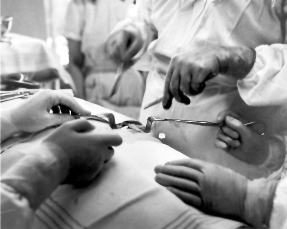 "Gallstensoperation" (huden och den yttre muskulaturen har skurits igenom och bukhinnan skymtar i operationsfältet). Doktor Sam Pettersson. Från utställningen "Falköping i bild" 1952.
