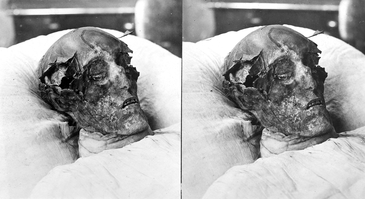 Karl XII:s mumifierade lik i papier maché. -Köpings museum / DigitaltMuseum